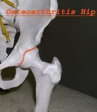 hip joint marked with problem area