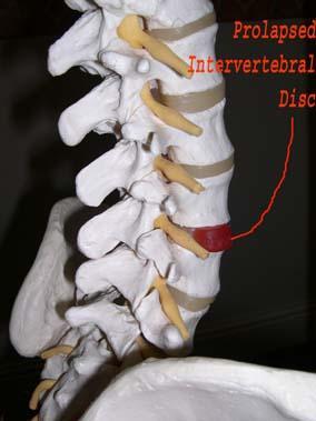 Model of Spine showing Prolapsed Disk